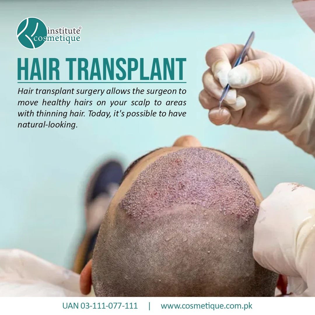 A surgeon performing hair transplant surgery at Cosmetique, moving healthy hairs to a balding area for natural results. Best hair transplant in Pakistan.